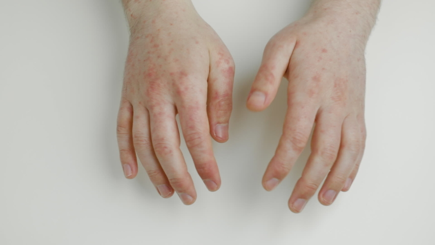 Man shows hand palms with allergic reaction or by-effect from taking medicines, antibiotics, scratches itchy red spots on skin. Close up shot | Shutterstock HD Video #1090459367