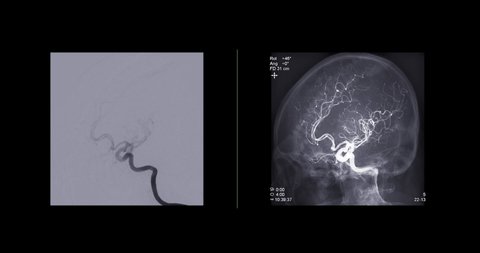 Cerebral angiography  from Fluoroscopy in intervention radiology  showing cerebral artery for diagnosis cerebral artery aneurysm.
