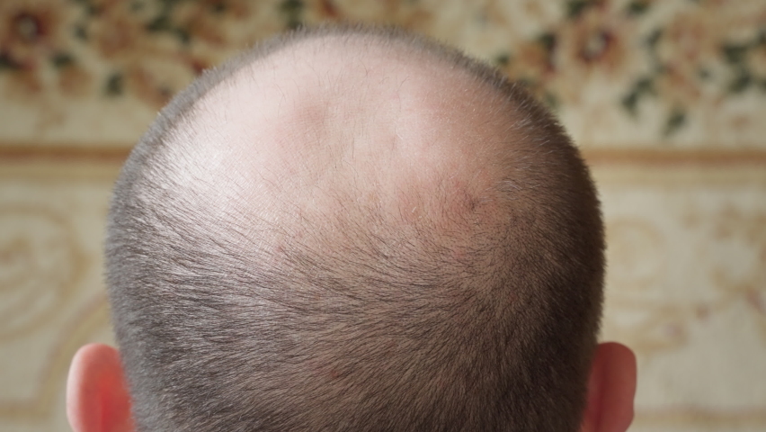 men hair loss problem. balding head close top view. man with hair loss problems hand touches the part of the head suffering from baldness. balding male concerned about hair loss. male pattern baldness Royalty-Free Stock Footage #1090649895