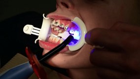 The use of ultraviolet light during the installation of braces, braces on the upper jaw crooked teeth.