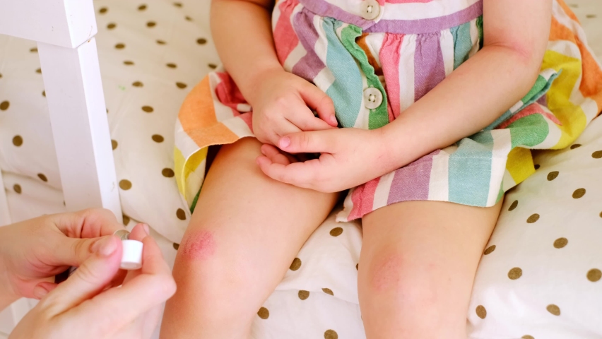 Red rough wounds on baby's knees. Mom applies cream from tube to ill, disease skin of child suffering from atopic dermatitis. Ointment for relieving symptoms of allergic disease. Care delicate  Royalty-Free Stock Footage #1090740933