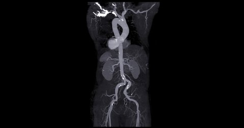  CTA Whole aorta Angiography view  turn around on the screen for diagnosis Aortic dissection or aneurysm.