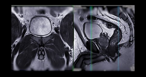 Compare of MRI prostate gland coronal and agittal T2W for diagnosis prostate cancer cell in aged men.
