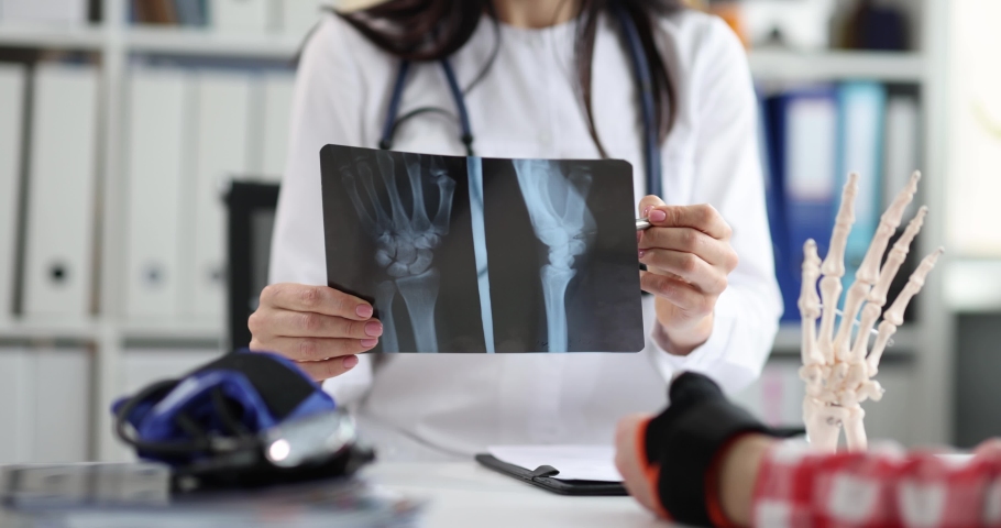 Doctors point to x-ray medical imaging with hand bone disease Royalty-Free Stock Footage #1090959247