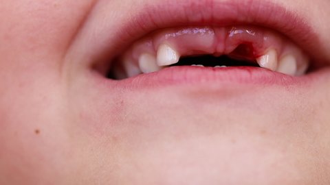 Closeup of unrecognizable child mouth with no milk teeth on front, remove from mouth. Kid dentistry industry. Cropped hand hold lips to show gingiva. Show no primary baby teeth on front. Success treat