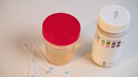 A close-up of a medical laboratory scientist diagnosing of ketonuria by using ketone screening test strip. Litmus paper changes color. Glucose in urine. Diabetes. High levels of sugar in human body