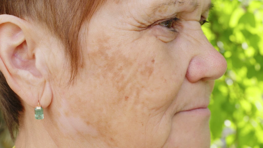 Portrait of elderly woman with spots on skin of face. Pigmentation on female face. Close up. Side view Royalty-Free Stock Footage #1091116553