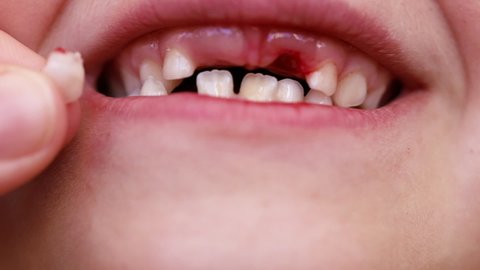 Closeup of unrecognizable baby mouth with no milk tooth, remove from mouth. Children dentistry, dentist industry. Show no primary baby teeth on front. Cropped hand holding tooth near mouth. Treatment