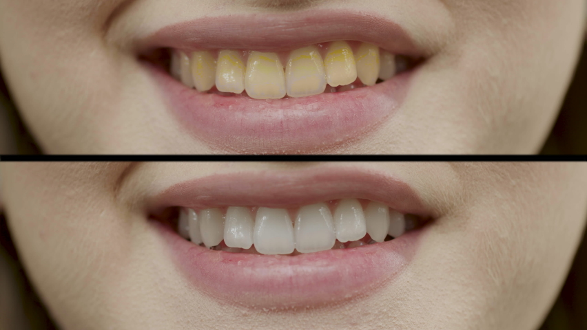 Smile change before and after, teeth whitening treatment. | Shutterstock HD Video #1091208567