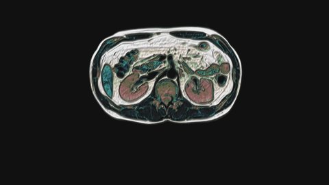 Bulk multicolored CT scan of the abdomen. Computed tomography of the gastrointestinal tract, liver and kidneys