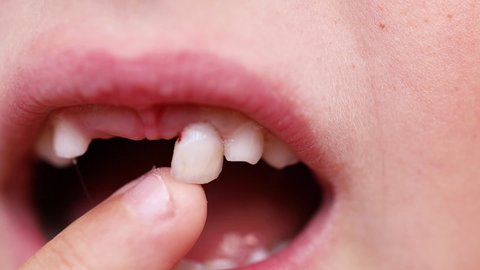 Cropped close up kid mouth, baby teeth problem. Touching by hand finger sagging front milk tooth. Dental care. Help to remove out mouth. Shaking tooth in gingiva. Changing teeth to permanent. 