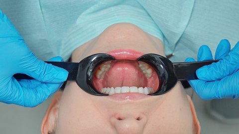 Installation of a black rigid retractor in the patient's mouth. dentist and his assistants provide assistance to patient. Helping a patient with caries and brushing teeth at doctor's appointment.