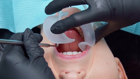 Installation of a white soft retractor in the patient's mouth. dentist and his assistants provide assistance to patient. Helping a patient with caries and brushing teeth at doctor's appointment.