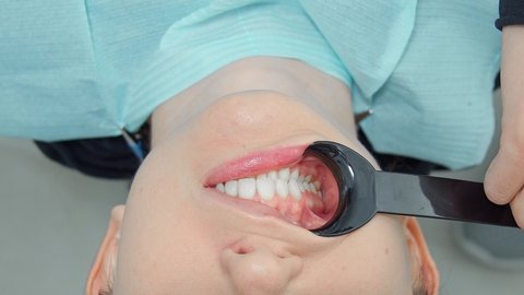 Photo of the patient's jaw using retractors and a mirror. The dentist and his assistants provide assistance to the patient. Patient care for caries and brushing teeth