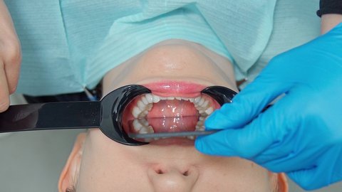 Photo of the patient's jaw using retractors and a mirror. The dentist and his assistants provide assistance to the patient. Patient care for caries and brushing teeth