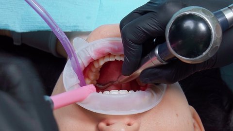 The doctor and the assistant clean the patient's teeth. The dentist and his assistants provide assistance to the patient. Patient care for caries and brushing teeth