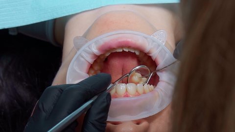 Instructional video with mistakes of the dentist and assistant. The dentist and his assistant assist the patient. Patient care for caries and brushing teeth