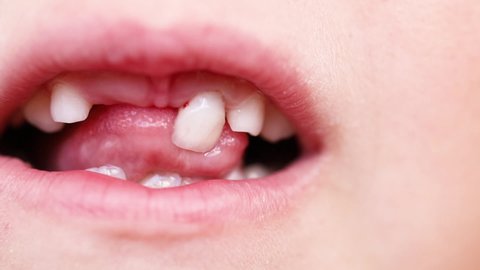 Unrecognizable closeup child mouth, baby white milk teeth changing. Touch by tongue swinging primary tooth. Shaking tooth in gingiva. Changing teeth to permanent. Health and dental care. Soon fell out