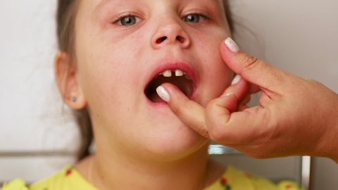 Woman hand checking little tearful girl loose tooth with finger closeup, white blurred background. Face of anxious child, milk tooth extraction. Concept of healthy teeth and beautiful smile.