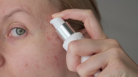Woman applying cream treatment on post acne scars