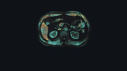 Bulk multicolored CT scan of the abdomen. Computed tomography of the gastrointestinal tract, liver and kidneys