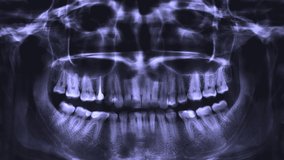 Stop motion video of human teeth panoramic X-Ray image. Internal composition of a human jaws. Teeth scan. Tooth fillings photo. Dental nerve removal. Medical background concept. Teeth X-Ray