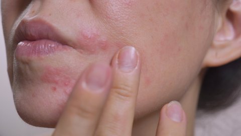 Close-up of a woman's face. Skin texture with a problem on the skin The girl touches the fingers of the problem skin of the face, considering this. Problem skin care concept, allergy