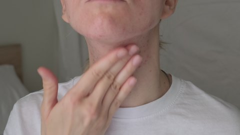 Young Caucasian woman with problematic skin applying treatment cream on her neck