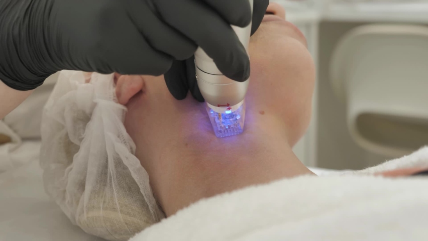 Procedure of Micro-Needle RF Lifting Neck Skin Close Up | Shutterstock HD Video #1091704285