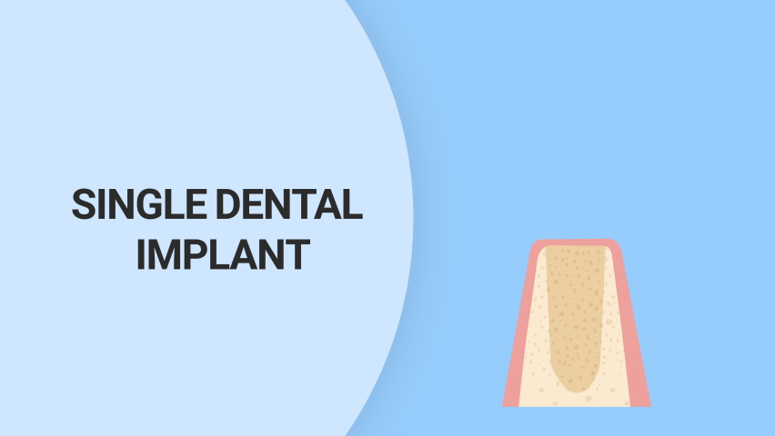 Dental Implant Procedure Explained Step by Step | Shutterstock HD Video #1091723965