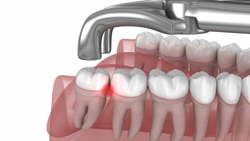 Wisdom tooth and gum inflammation, extraction of teeth. Medically accurate tooth 3D animation  | Shutterstock HD Video #1091863439