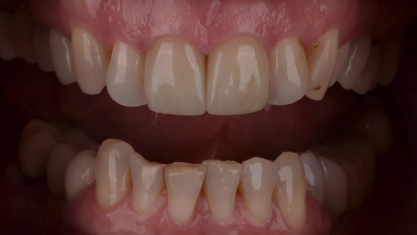 Smile makeover with ceramic veneers result in perfect natural smile | Shutterstock HD Video #1092094433