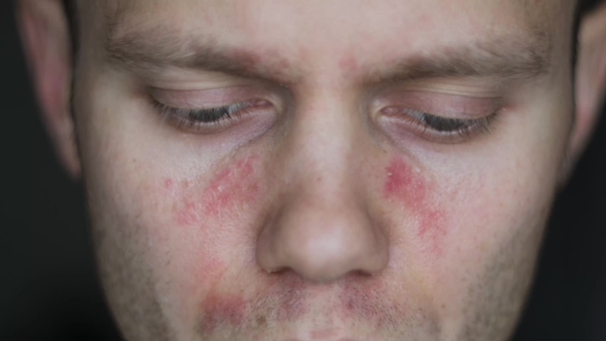 allergic reaction on the face of a young man, symptoms of chronic urticaria autoimmune lupus. Royalty-Free Stock Footage #1092424011