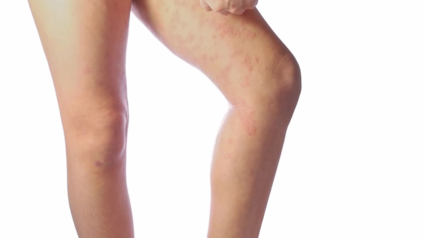 Acute atopic dermatitis on the legs behind the knees of a child is a dermatological disease of the skin. Large, red, inflamed, scaly rash on the legs. Legs of a teenager with severe atopic eczema. Royalty-Free Stock Footage #1092478263