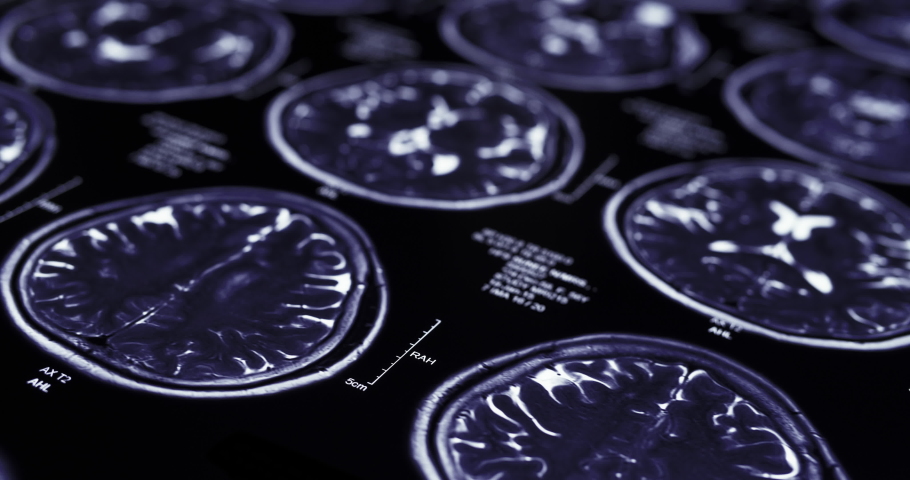 Slider shot of MRI brain scan
