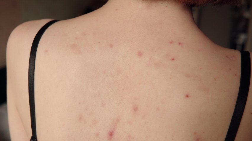 Close-up view of acne sequelae, torn pimples, skin itching on the back, dermatological problem. High resolution shot. Royalty-Free Stock Footage #1092815379