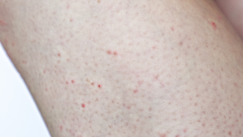 Close-up of the leg skin covered with red rash, pimples and irritation. Concept of scabies, allergy and cosmetology Royalty-Free Stock Footage #1092846031