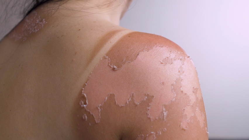 The woman scratches her shoulder with her hand. Red spots on the shoulder Cutaneous psoriasis. Sunburn, tanning. Royalty-Free Stock Footage #1093004453
