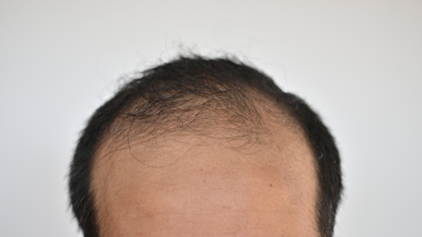 Close up of unidentified Asian man worried about his hair loss and baldness problem. Conceptual of hair problem on men's head. | Shutterstock HD Video #1093254879