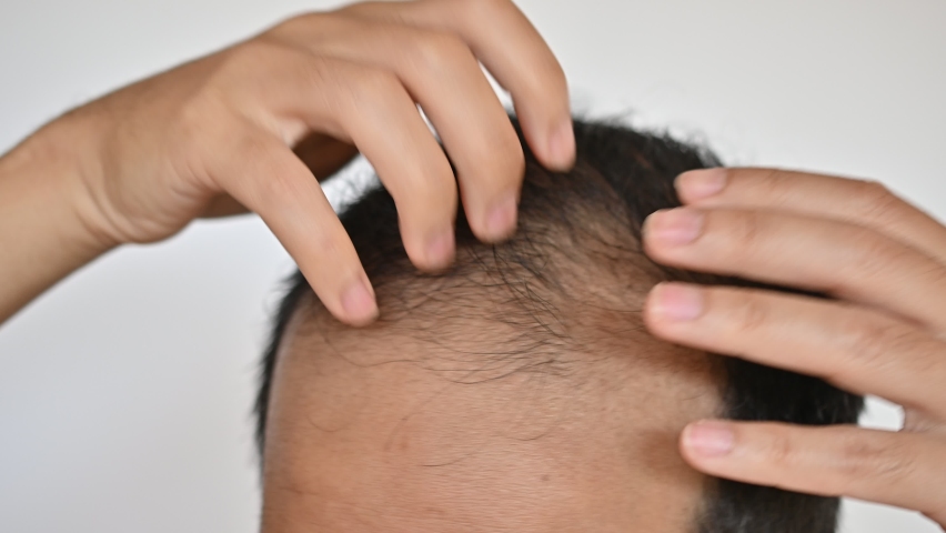 Close up of unidentified Asian man worried about his hair loss and baldness problem. Conceptual of hair problem on men's head. Royalty-Free Stock Footage #1093254879