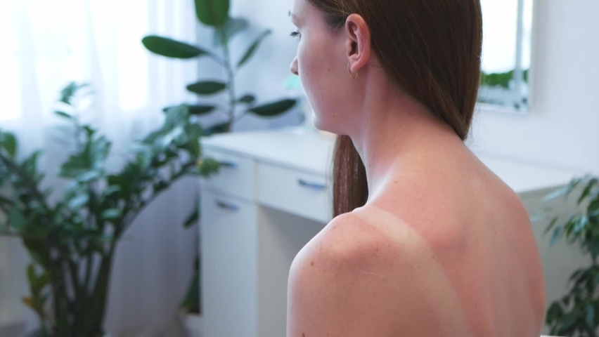 Red hair woman smears back with gel from sunburn marks. Woman with reddened itchy skin after sunburn smears cream on the skin. Concept of sunbathe without sunscreen. Royalty-Free Stock Footage #1093432349
