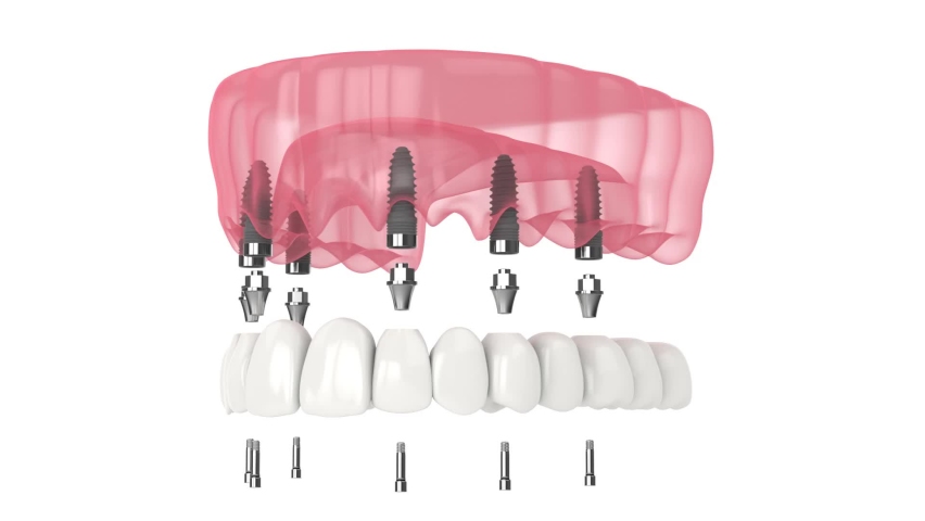 Dental prosthesis all-on-6 system supported by implants | Shutterstock HD Video #1093559107