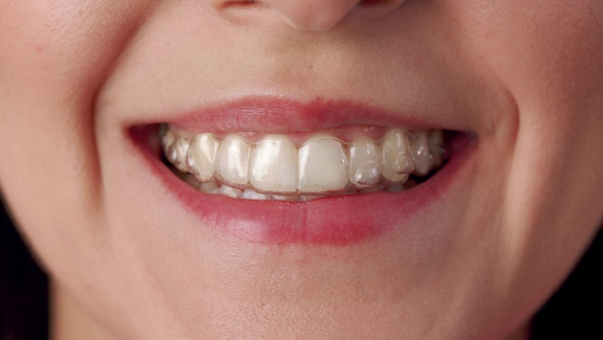 Close-Up View On Smile Young Woman With Invisalign Braces, Putting On Transparent Plastic Retainers And Smile. People And Style Concept. Clear And Removable Aligner Retainer Or Tooth Whitening System | Shutterstock HD Video #1093607043
