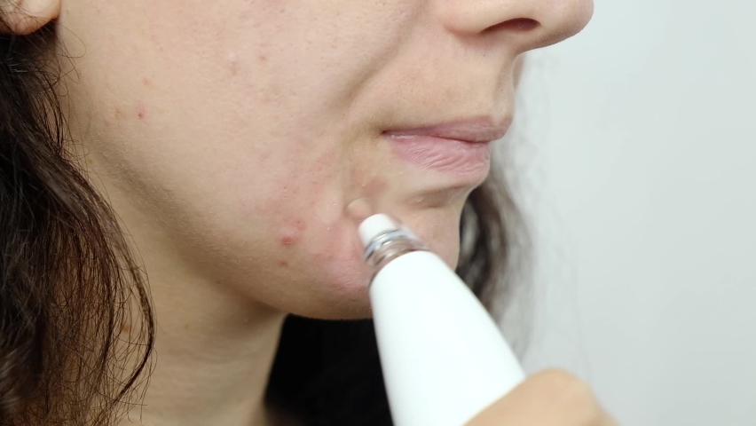 Woman face and vacuum face pore cleaner, cosmetic skin care High quality FullHD footage | Shutterstock HD Video #1093677363