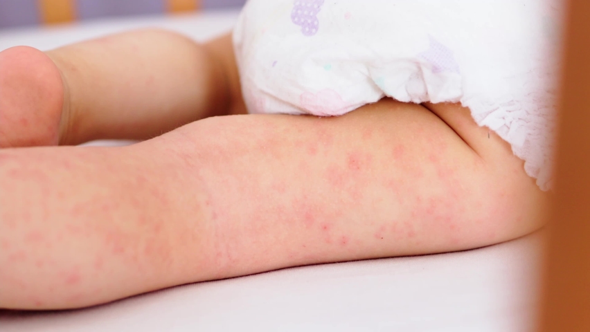 Allergic skin on child's legs, red rash dermatitis, close-up atopic eczema allergy. baby kid atopy diathesis reaction on food, irritation dermatology problem skin. medicine itchy illness | Shutterstock HD Video #1093848027