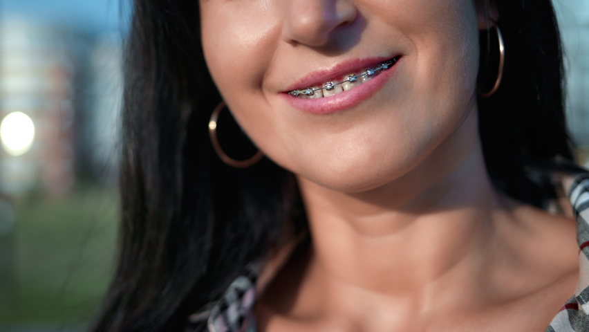 Smiling female mouth with teeth in braces adorable brunette woman posing summer sunset outdoor city street closeup. Beautiful woman smile medical orthodontics dental hygiene dentistry stomatology 