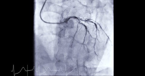 Coronary Angiogram Coronary Artery During Cardiac Stock Footage Video ...