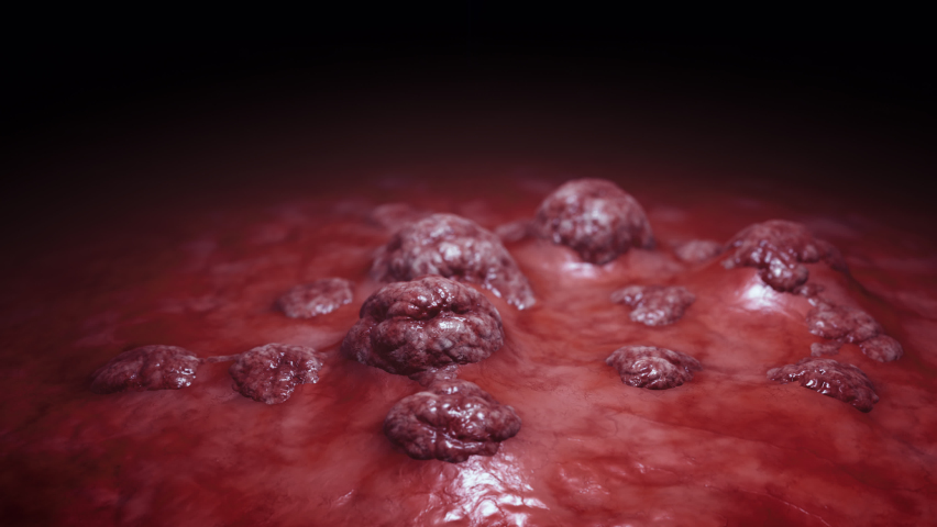 Cancer cell growth animation. Tumor growing and spreading over healthy tissue causing inflammation and metastasis. 