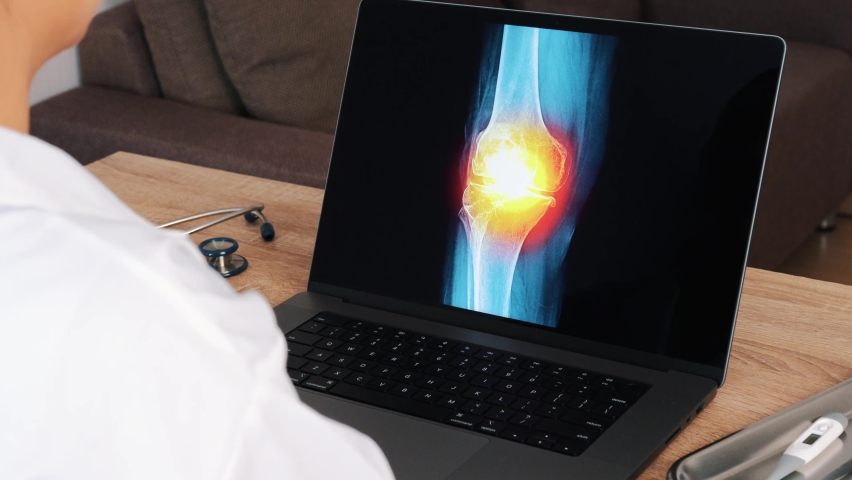 Woman Doctor showing x-ray with pain in a knee on a laptop. Left to right shot Royalty-Free Stock Footage #1094315903