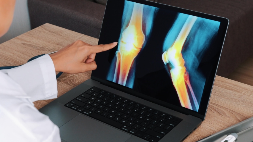 Woman Doctor showing x-ray with pain in the knees and legs on a laptop. View above the shoulder Royalty-Free Stock Footage #1094315923